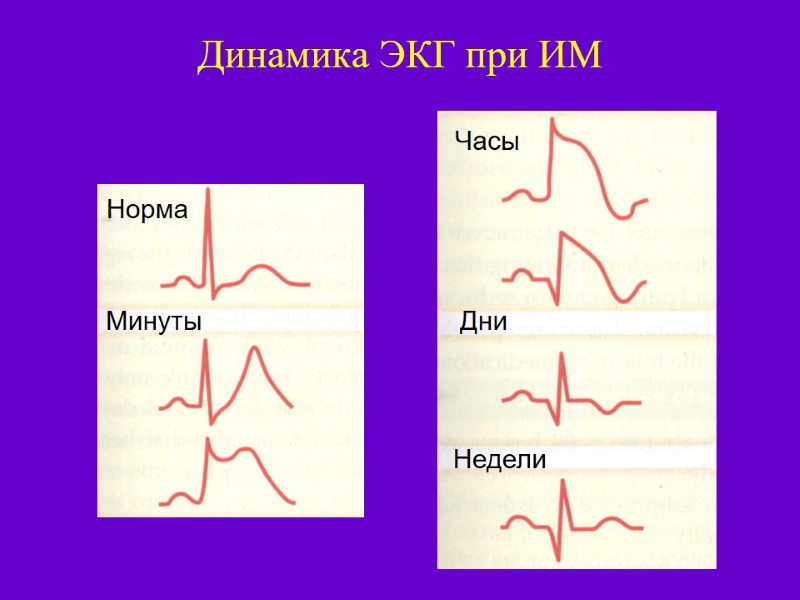 Динамика ЭКГ при ИМ Норма Минуты Часы Дни Недели